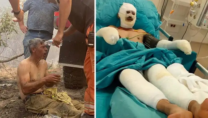 Orman İşçisinin Yanık Tedavisi: Doğa Kahramanı Hayatta Kalma Mücadelesinde